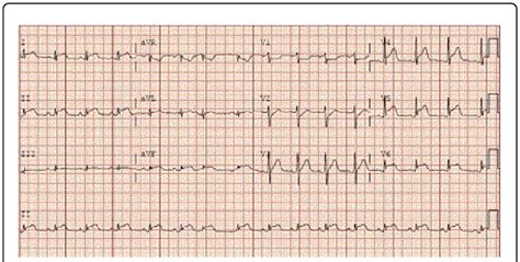 mild ventricular hypokinesis.